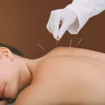 acupuncture